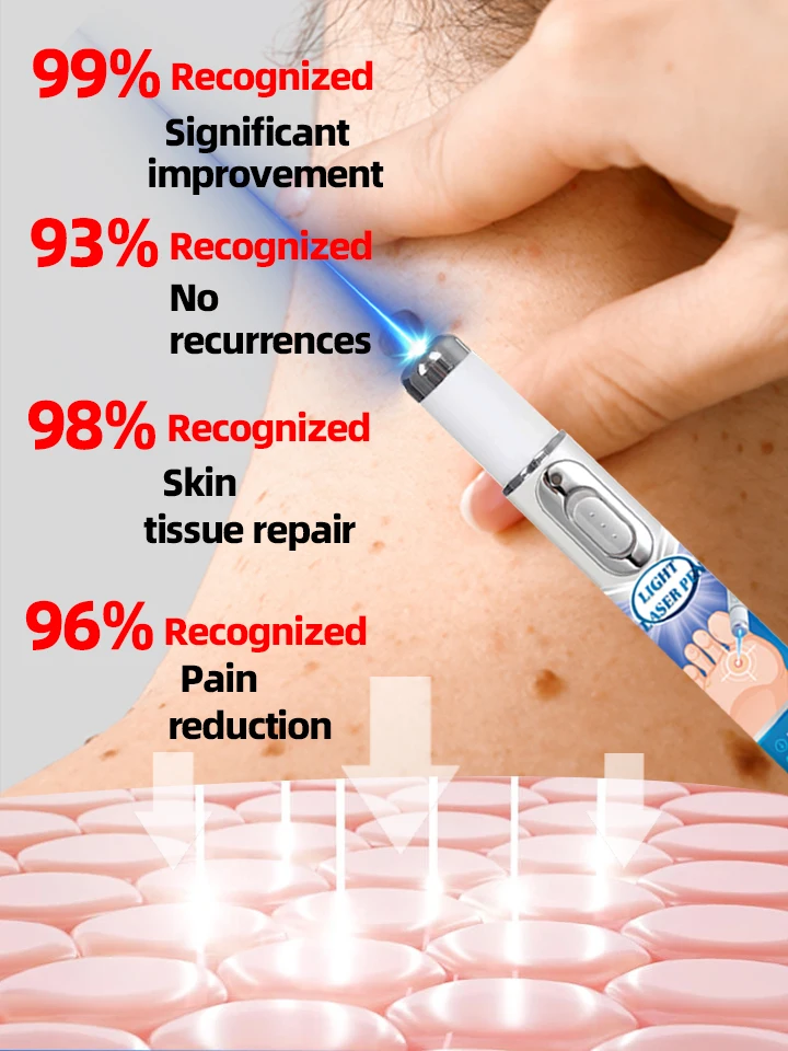 Herramientas para el cuidado de verrugas, bolígrafo de luz azul muy vendido para resolver verrugas corporales