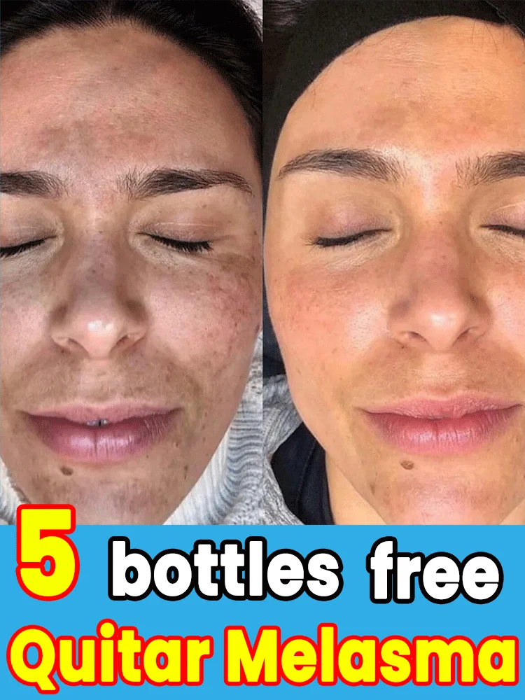 

Effectively remove freckles, beautiful and charming, making you younger