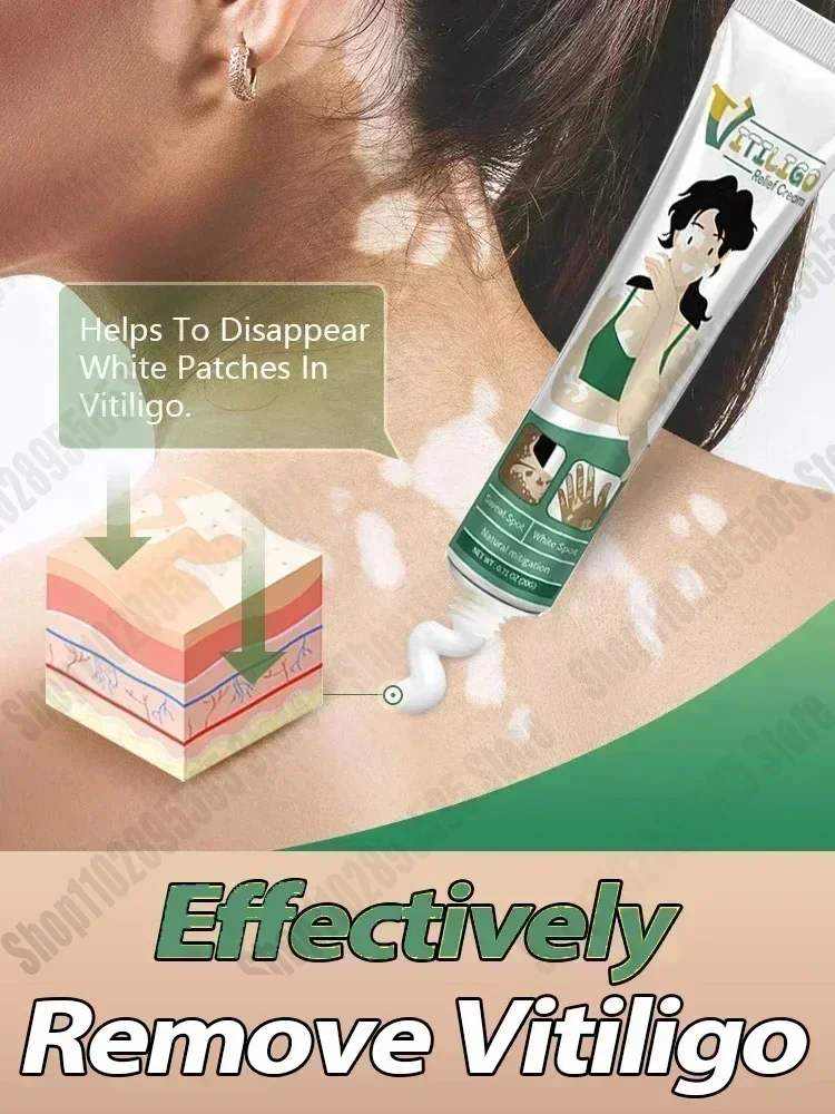 ขายร้อนผู้ขายที่ดีที่สุดจุดสีขาวสําหรับ Vitiligo จุดสีขาว Leukoplakia เมลานินส่งเสริม Vitiligo Skin Care