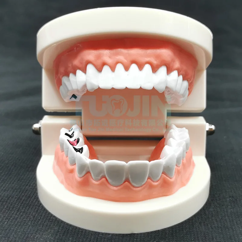 Dental child tooth decay model, kindergarten brushing teaching nursing model, oral teaching dental pathology model
