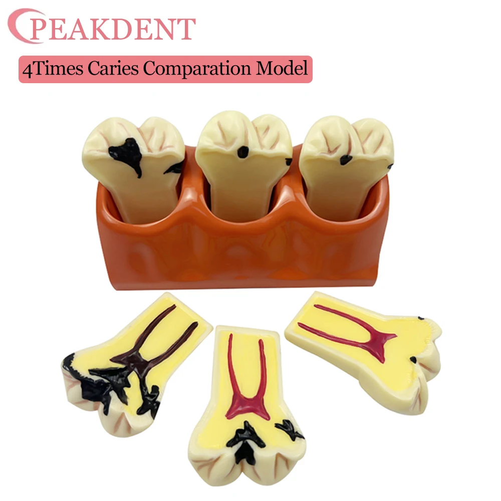 4Times Caries Comparation Models Caries Decomposition Dissected teeth model Dental Model For Dentist Studying and Researching