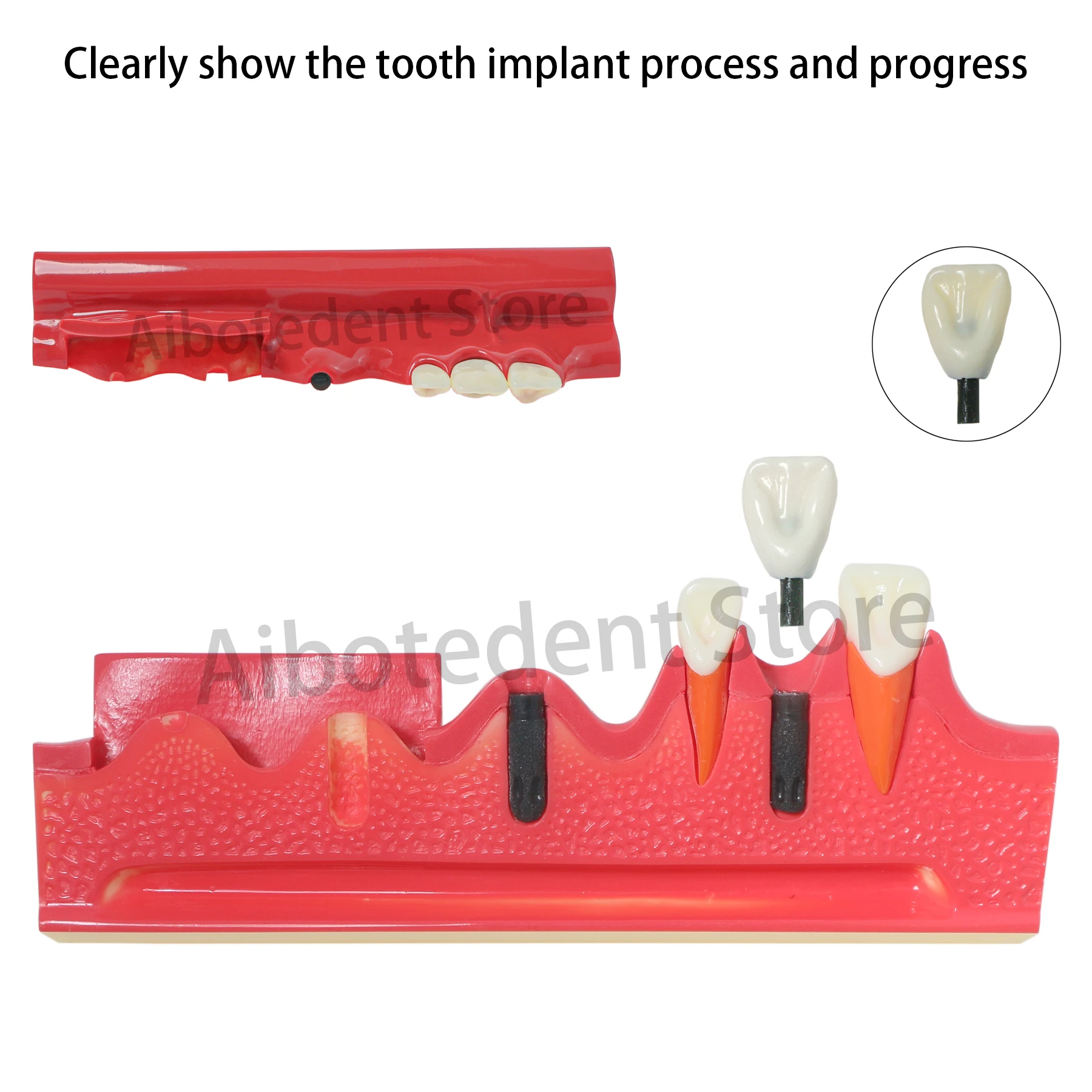 

Dental Implant Model Tooth M2018 Study Show the Tooth Implant Process Progress