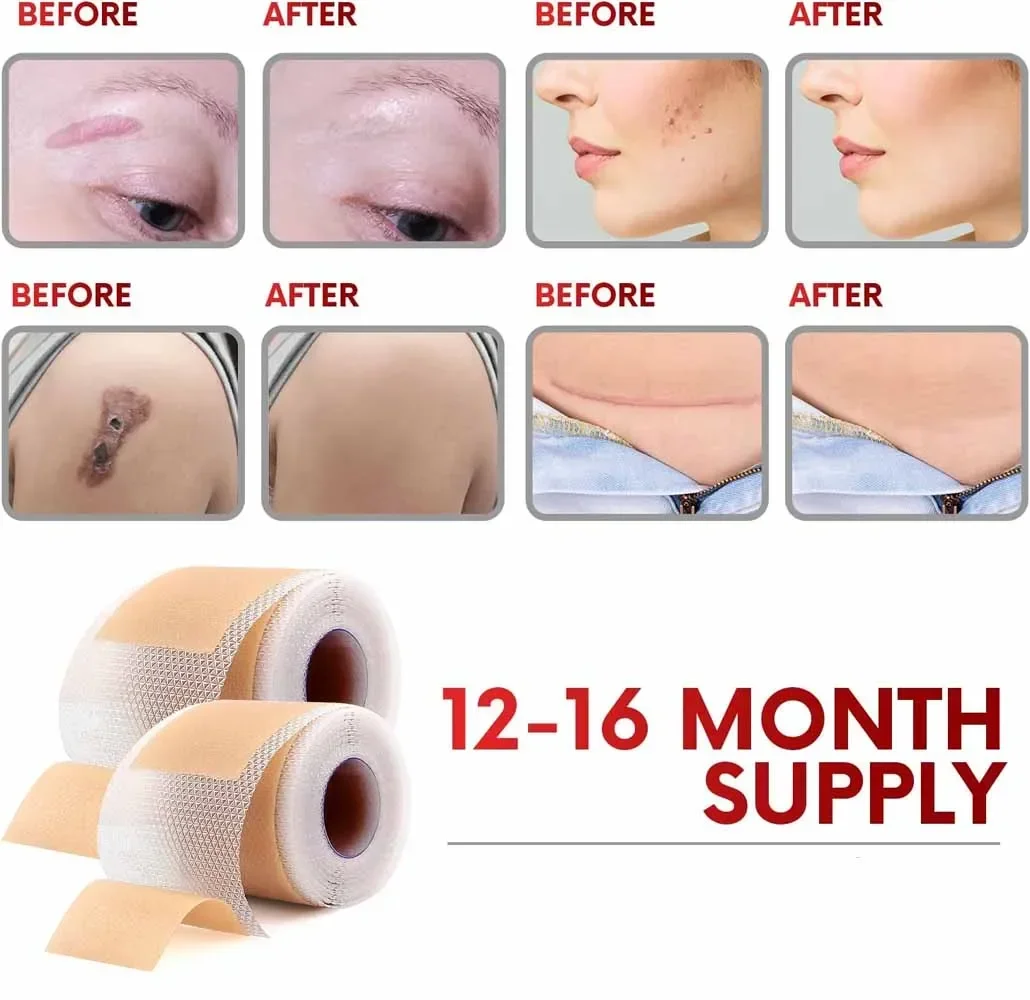 1 Roll Silicone Scar Sheets, Silicone Scar Tape Roll,Reusable,Professional Scar Removal Sheets for C-Section,Surgery,Burn,Keloid