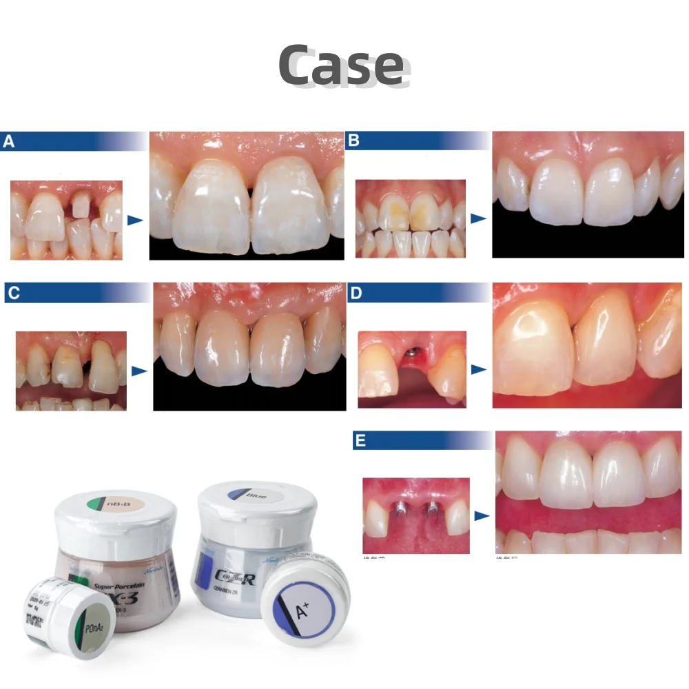 EX-3 مسحوق بورسلين لجسم الأسنان كوراراي نوريتاكي مسحوق بورسلين معدني فائق (50 جرام) شفاف A1/B1/E1 مواد مختبر الأسنان