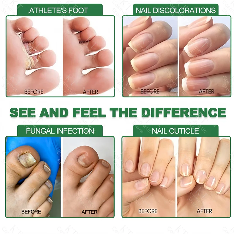 7 Days Nail Fungus Treatment Serum Ginger Anti-Infective Paronychia Onychomycosis Toe Foot Nail Fungal Repair Gel Hand Foot Care