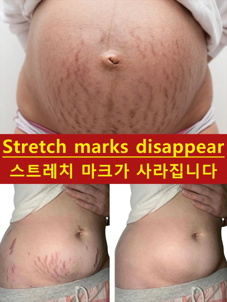 Stretch Mark Fading Serum Stretch mark essential oil suitable for pregnancy and the postpartum period; offers anti-aging, skin-firming, and skincare benefits, helps fade and repair stretch marks, and complements prenatal fitness routines.