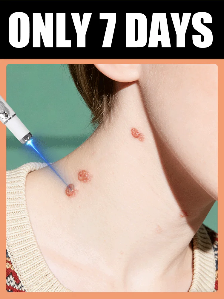 

Инструмент для удаления бородавок с синим светом, больше скидок на наборы, унисекс