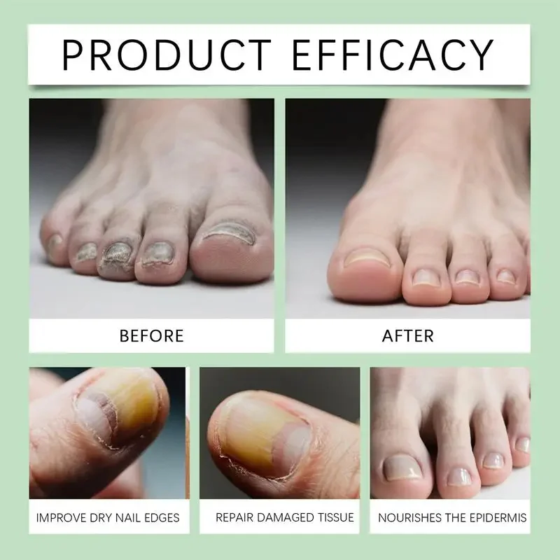 

Nail Fungal Treatment Serum Foot Toe Nail Fungus Removal Essential Oil Anti Infection Onychomycosis Paronychia Repairing Care