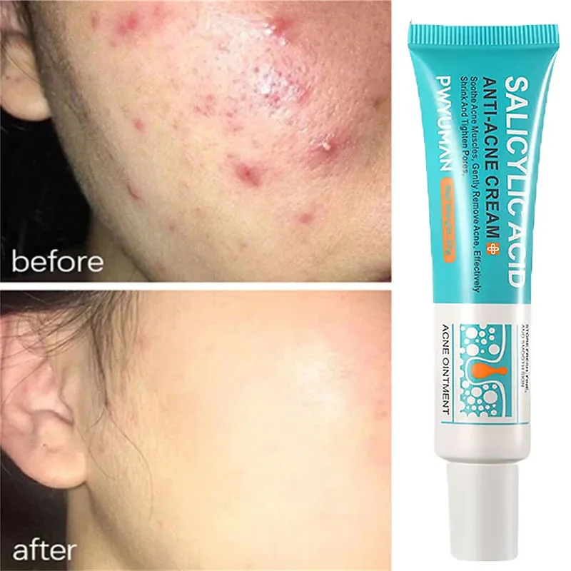 

Salicylic Acid Acne Treatment Face Cream Removal Pimple Spots Deep Cleaning Pores Anti-acne Oil Control Moisturizing Skin Care