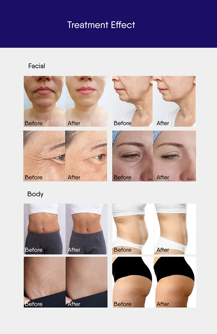 Fractional  Pen for  Resuacing, Elasticity Improvement, and Scar Reduction