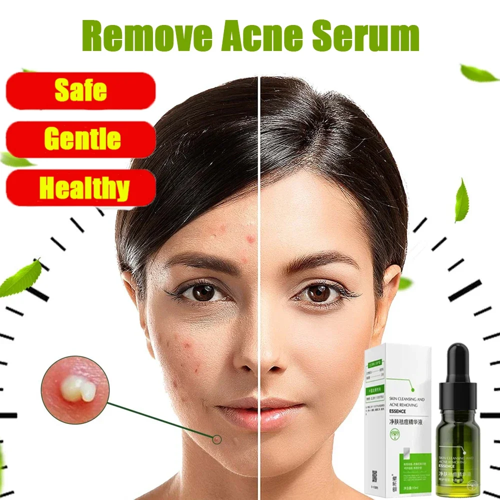 

Acne Remover Face Serum, Pimple Remover, Shrink Pores, Oil Control Skin