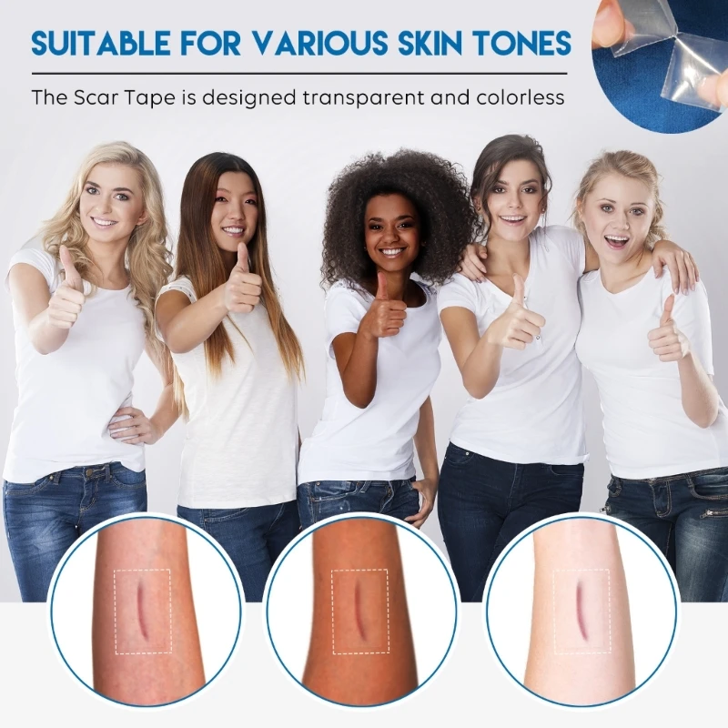 Phẫu thuật sinh mổ hiệu quả Gel Silicone Loại bỏ sẹo Tấm trị liệu Miếng dán trị mụn Chấn thương Đốt cháy Da phục hồi