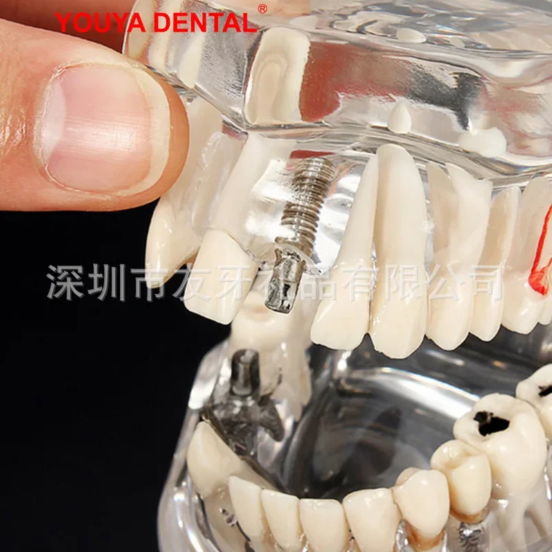 Dental Removable Oral Restoration Model Pathological Dental Model