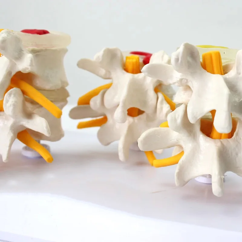 4-stage Pathological Human Lumbar Spine Anatomy Model Medical Science Teaching Tool