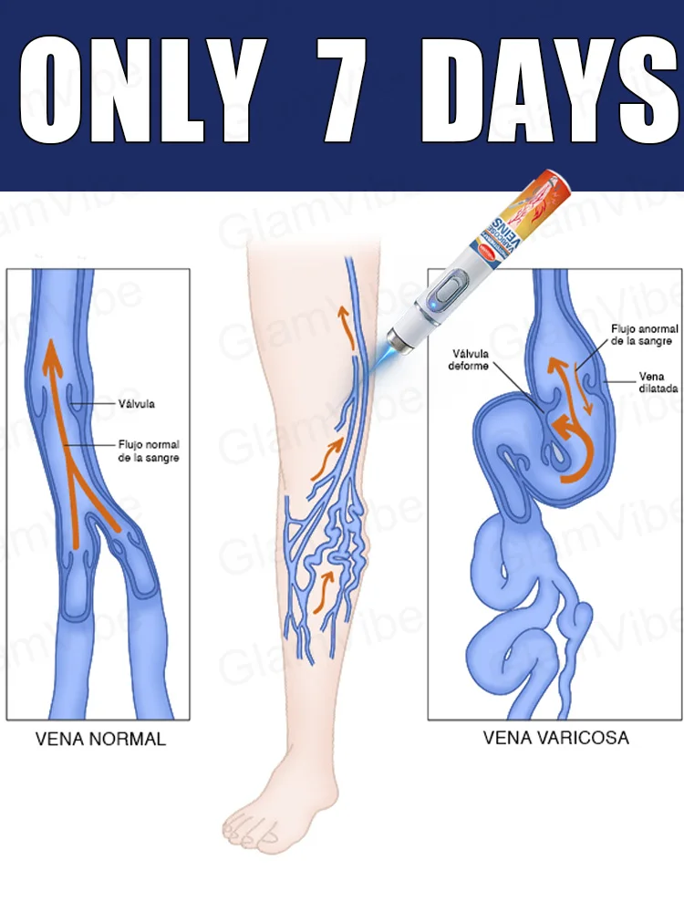 

blue light pen solve varicose veins, hot sale leg care tools