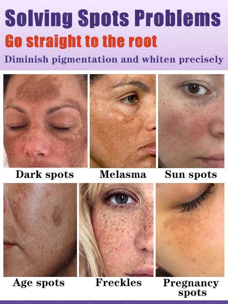 Creme de remoção de manchas escuras para rosto, melasma, sarda, idade, manchas solares, clareamento