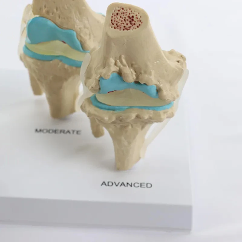 Human Knee Joint Model, Stage 4 Disease, Knee Bone Structure Display, Anatomical Model, Medical Teaching, Tabletop Decoration