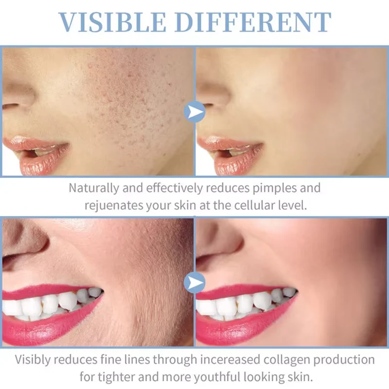 Thumbnail 3 - #17 Best Acne Treatments & Kits to Buy In 2026