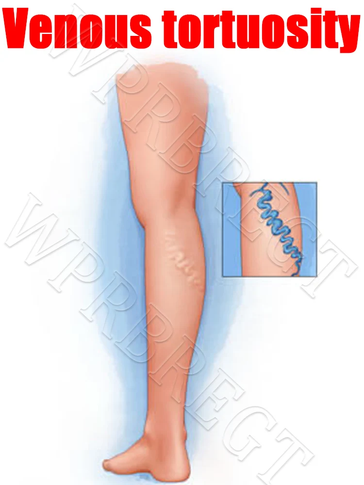Vein laser pointer, a new upgrade