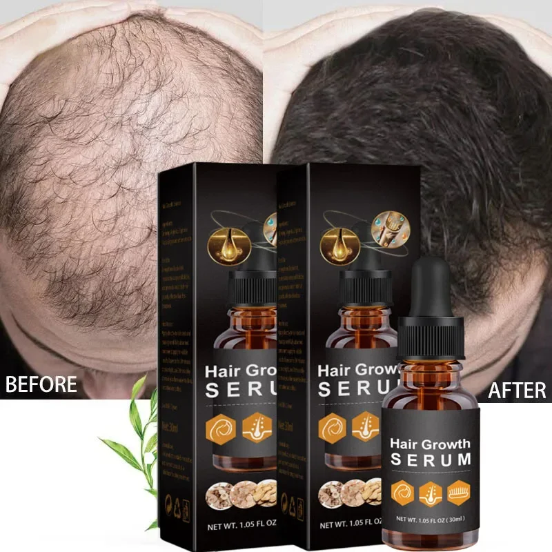 Huile essentielle de croissance rapide des cheveux pour hommes et femmes, prévention efficace de la perte de cheveux, sérum de traitement du cuir chevelu, croissance de la barbe