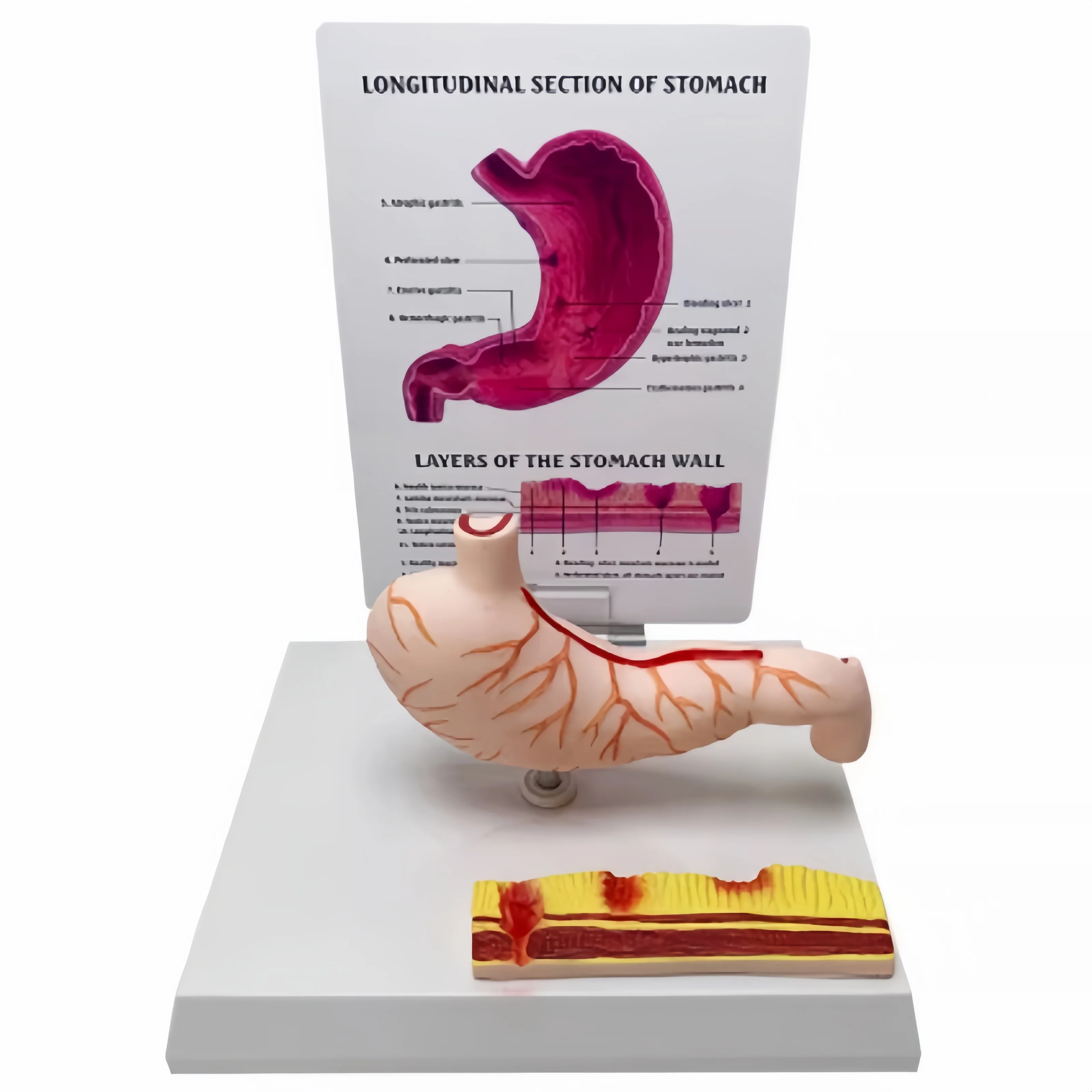 

Pathological Structure of Stomach Model Atrophied Gastritis Ulcer Perforated Human Digestive System Model