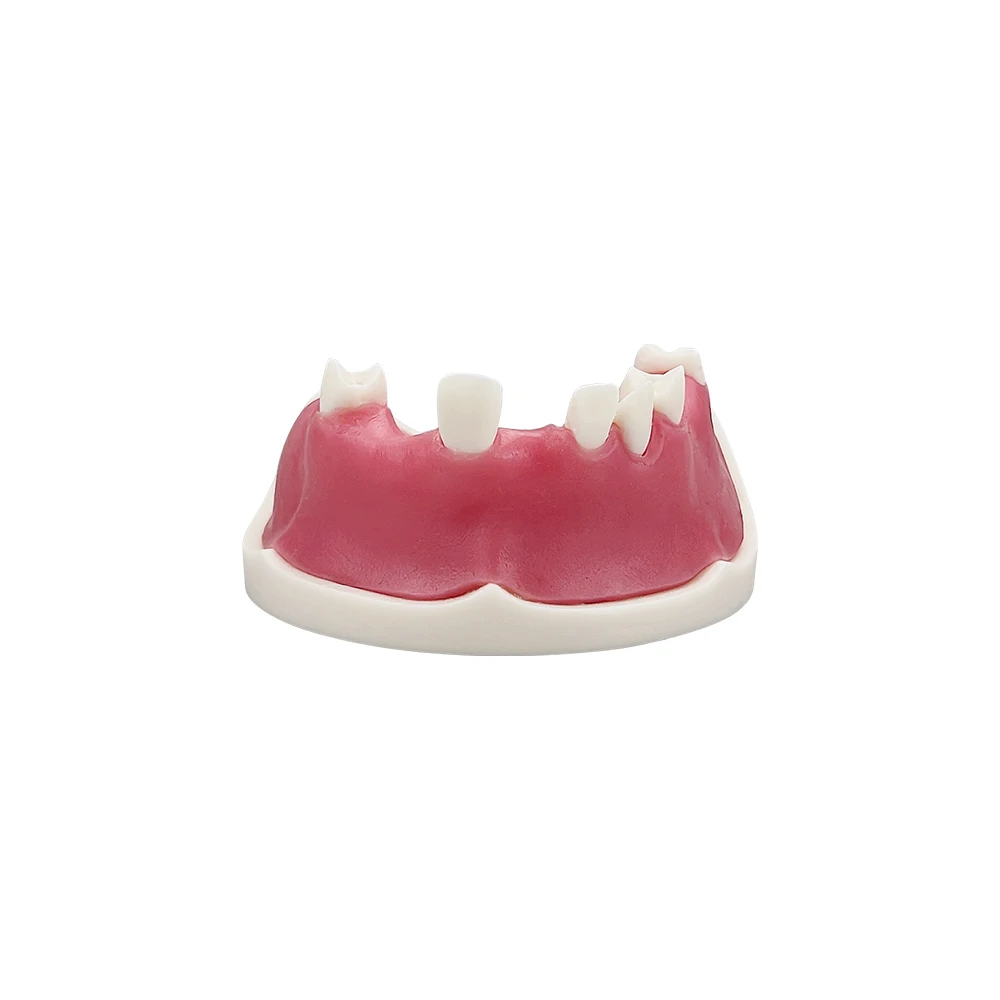 Typodont-modelo de implante Dental maxilar, dientes faltantes con práctica de encías blandas, modelo de entrenamiento para estudiantes, herramienta de práctica