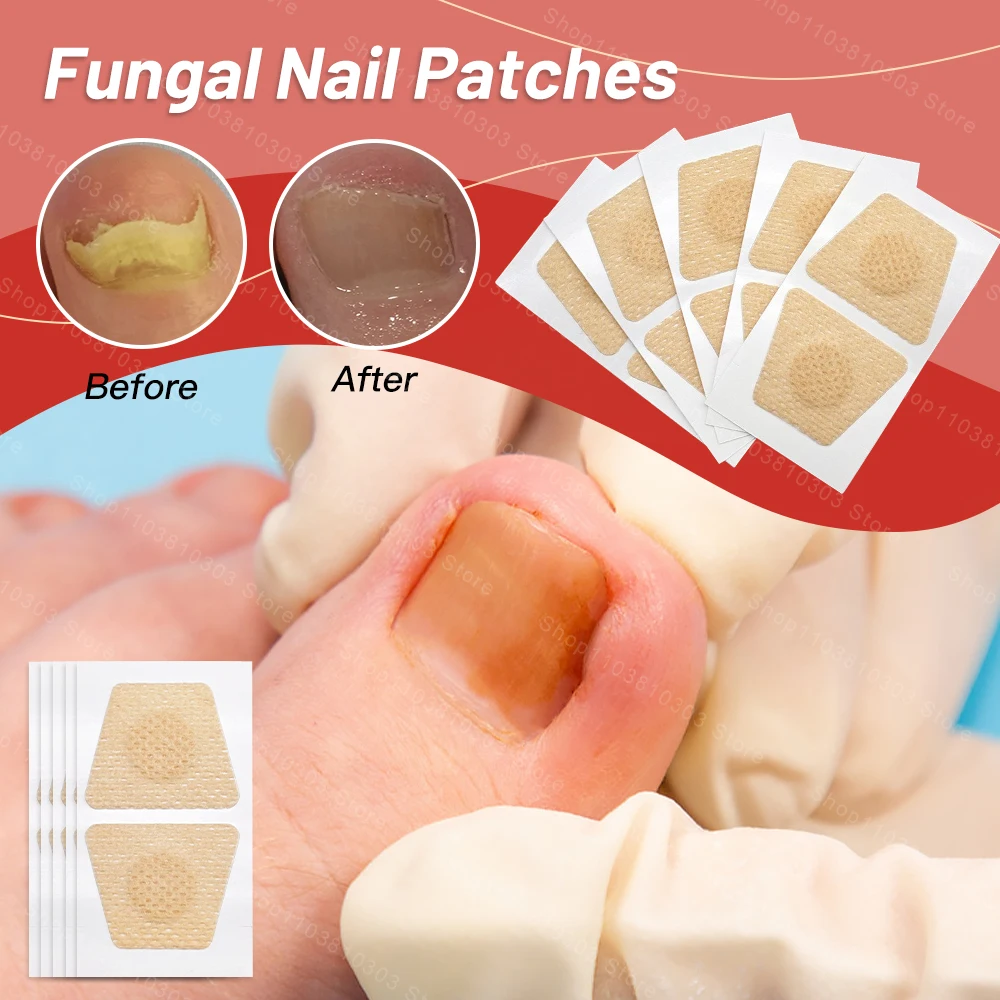 10/100 قطعة بقع الأظافر الفطرية أظافر أظافر رقعة إصلاح الإطارات مسمار نام تصحيح ملصق تغير لون التالفة مسمار قدم الرعاية