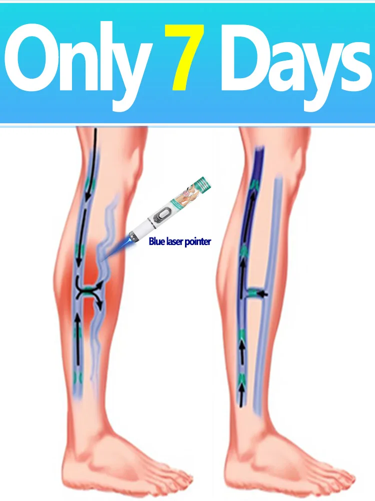 

3rd Generation Laser Pointer Varicose Veins and Spider Legs Restoration Laser Device Foot Tool Soothing