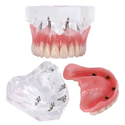 Modelo de dentes odontológicos com parte superior clara, 4 implantes, restauração overdenture, dentista explicar função overdenture