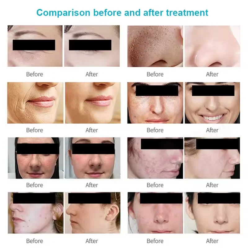 8 in 1 Skin Analyzer Facial Cleaning Microdermabrasion Diamond Water  Peeling Cleaning Machine