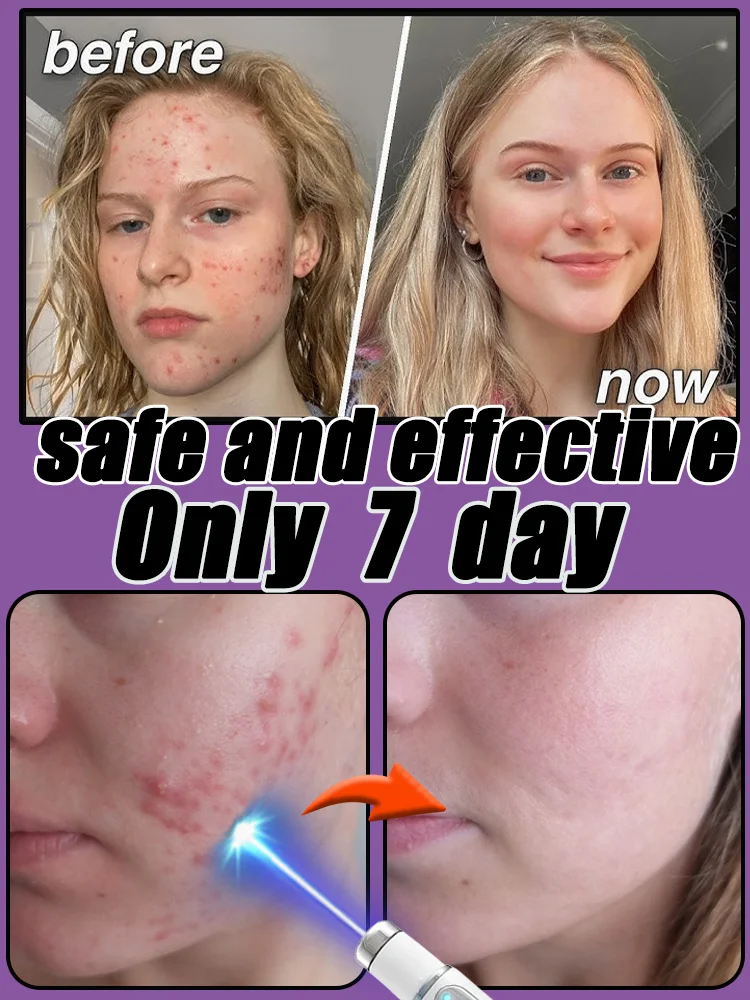 

Acne Anti Pimple Marks Disappears Instantly