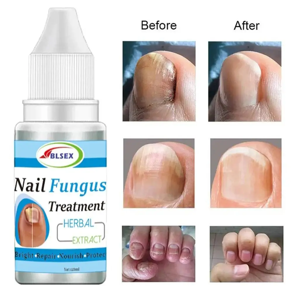 10ML Nail Repair Serum Nail Care Paronychia Fungus Nails Treatment Liquid Anti Infection Nail Repair