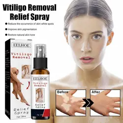 30ml Relief Spray Skin Moisturizing Vitiligo Net Spray Skin Repair Body Face Fades Vitiligo Spot White Spots Repair