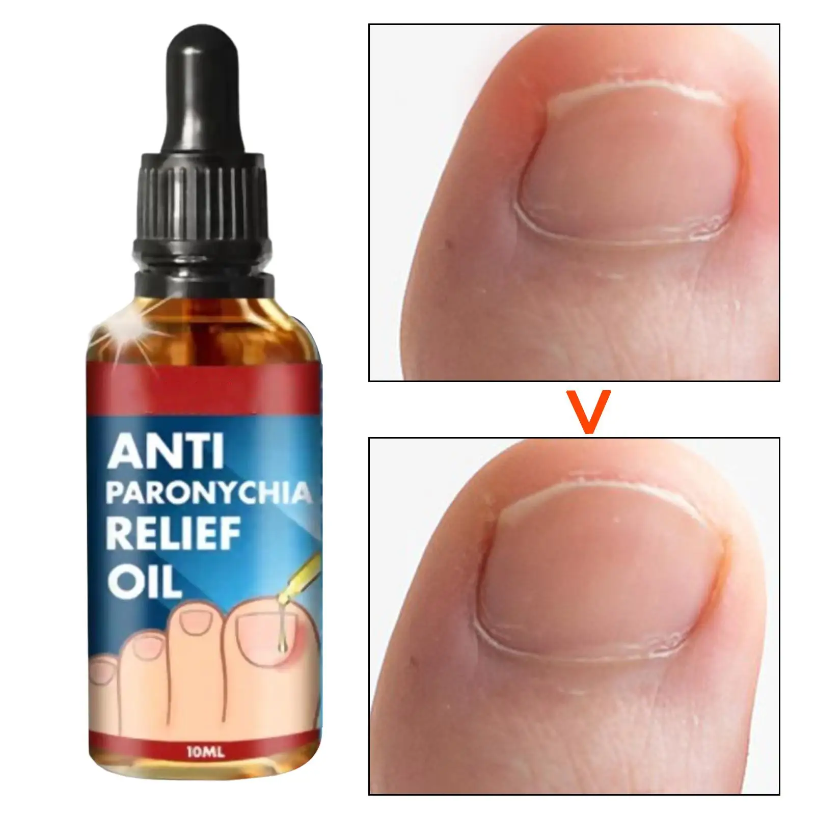 10ml Ingrown Toenail Treatment Oil Nail Renewal Liquid Toenail Repair Solution