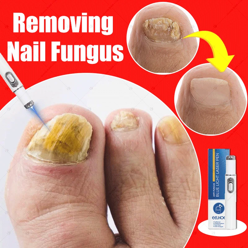 

laser pen A must-have blue light laser therapy device for families