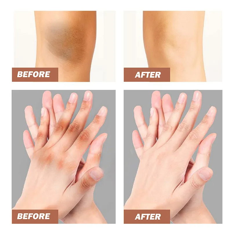 Dark Knuckles Fast Whitening Cream Hand Knuckle Elbows Knee Intense Stains Remover Cream Pigmentation Correctors For Black Skin