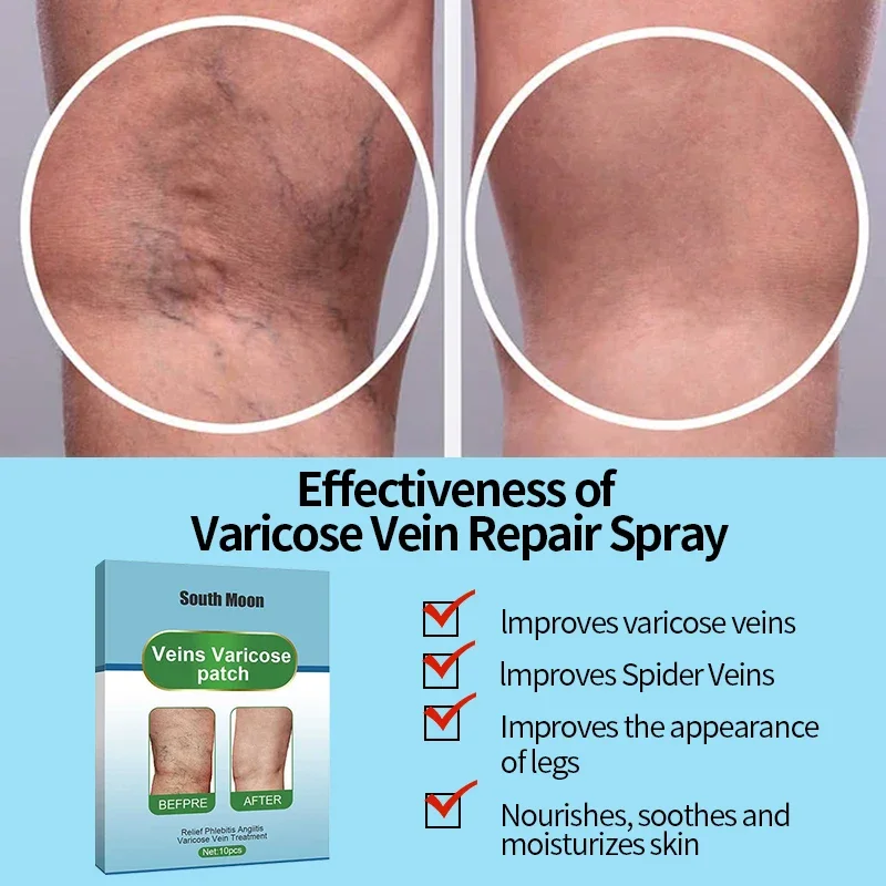 50Pcs Varicose Veins Relief Patch Spider Leg Vasculitis Phlebitis Treatment Varicosity Angiitis Legs Dilated Plaster Foot Care