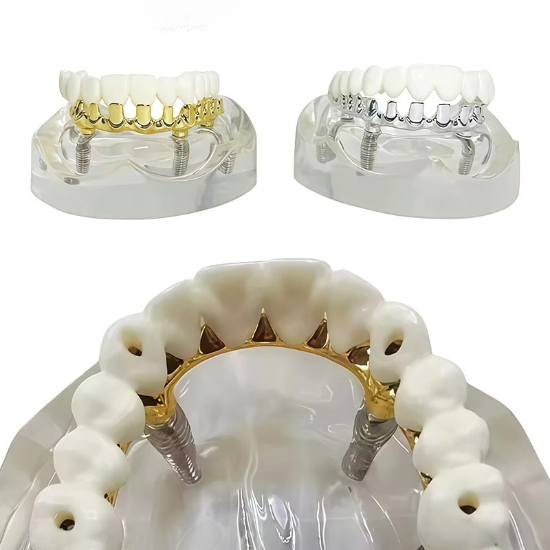 Dental Implant Model, Implant Restoration, Realistic Demonstration and Simulation for Teaching Four Dental Implants in The Mouth