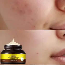 Acne remoção e acne remoção acne reparação e dessalinização de acne impressão creme