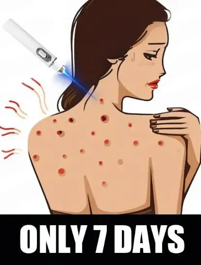 

Outil Wart Blue Light, а также изысканные уборы sur les