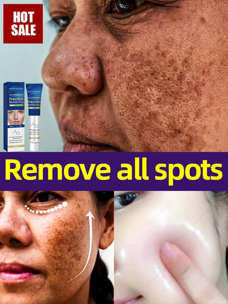 

Freckles Removal Cream Dark Spot Remover for Face Melasma