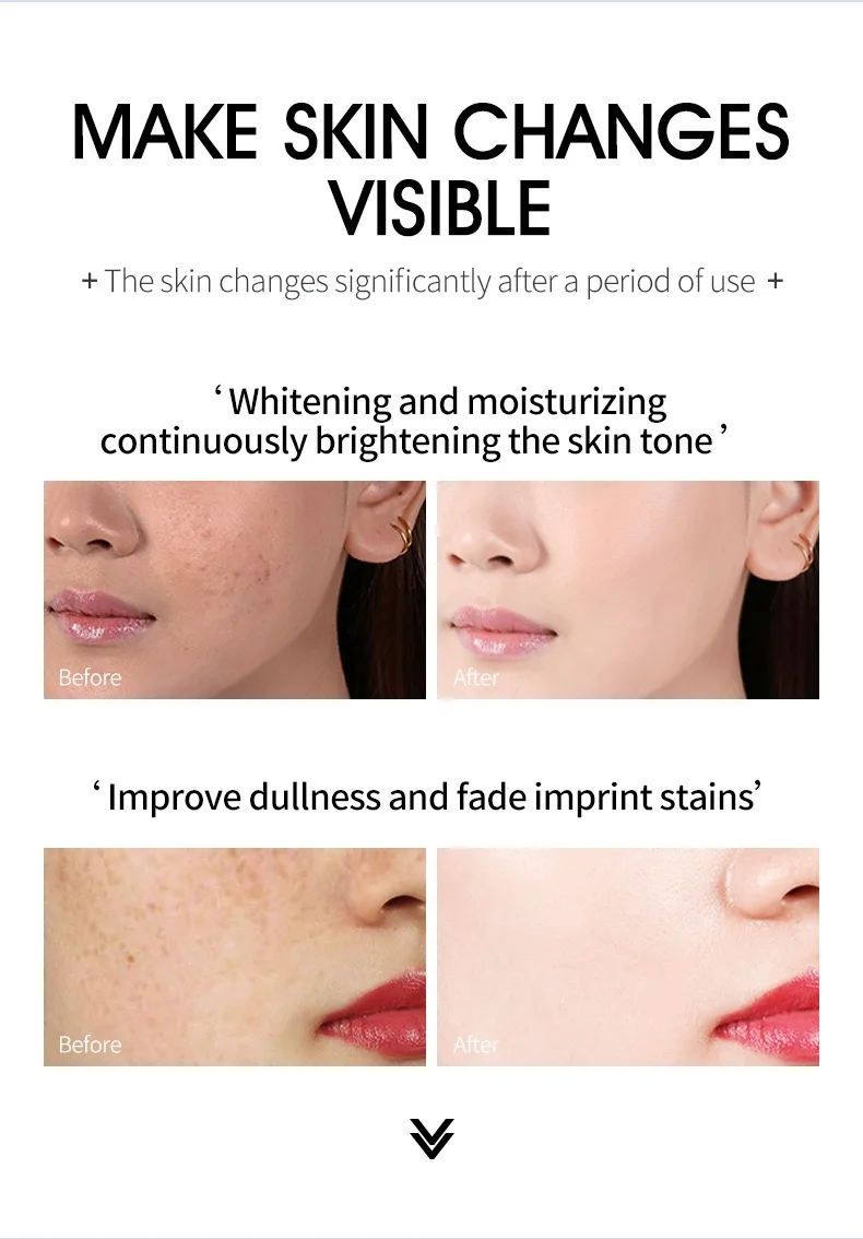 Durchdringung der Haut | Hiisees Whitening- und Akne-Entfernungscreme. Entfernen Sie Sommersprossen und Akne. Gelbe Entfernungs- und Aufhellungscreme