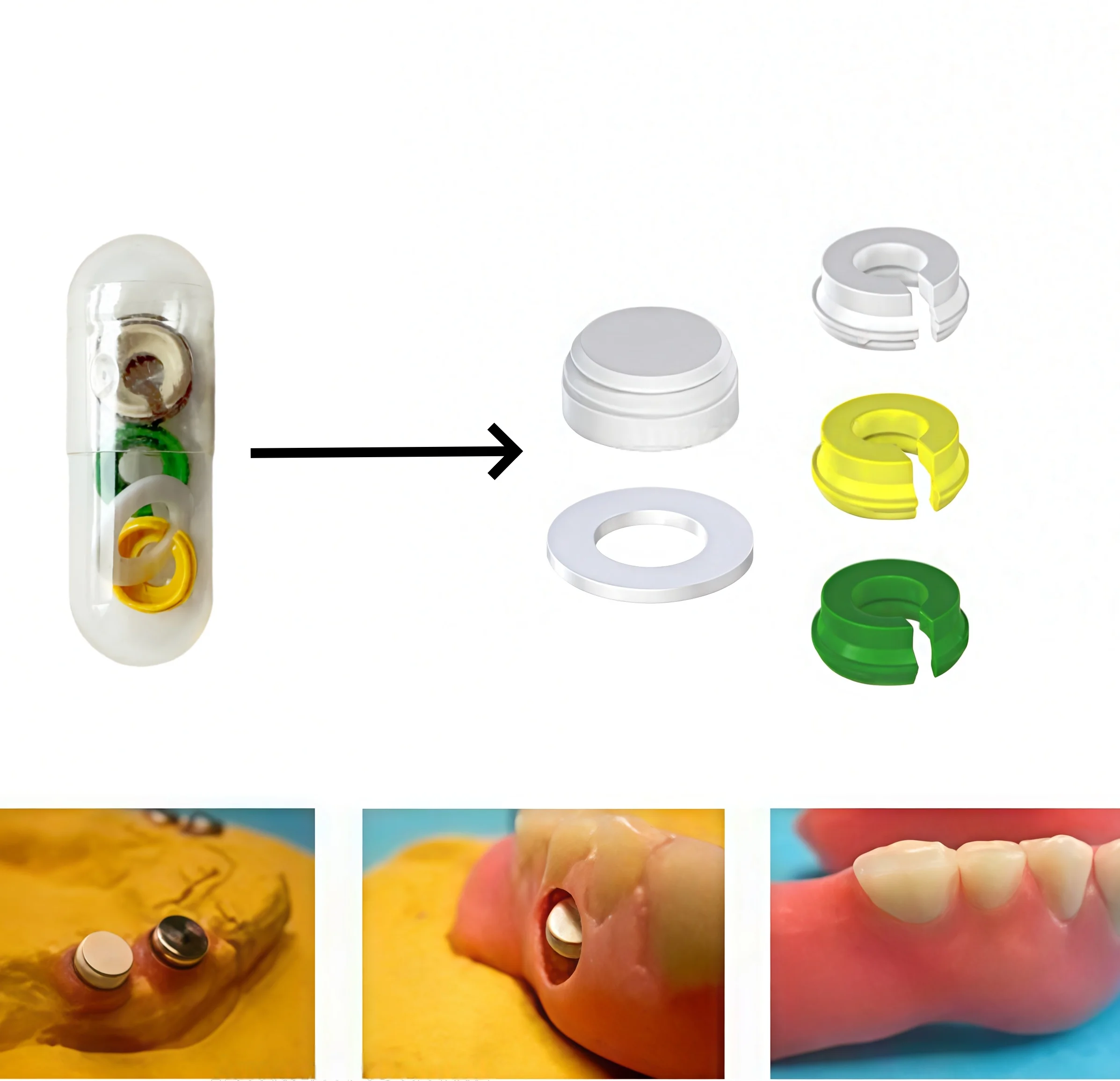 

Колпачки-вставки PEEK для абатментов с титановым корпусом, вставки для протезов, в стиле Novaloc