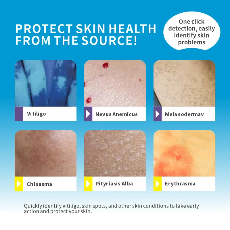 Draagbare houtlamphuidanalysator voor detectie van vitiligo psoriasis
