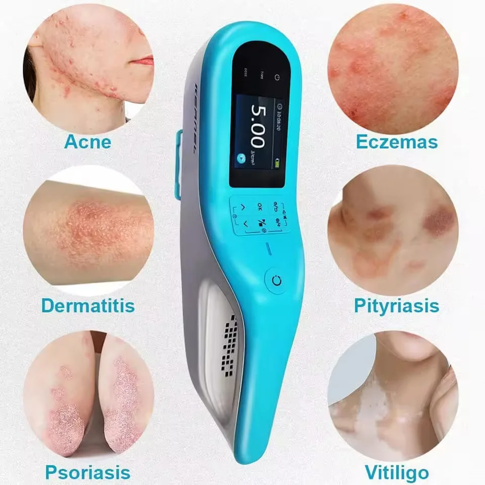 Portable 308nm UV Excimer Phototherapy Light Vitiligo Psoriasis Acne Rehabilitation Equipment