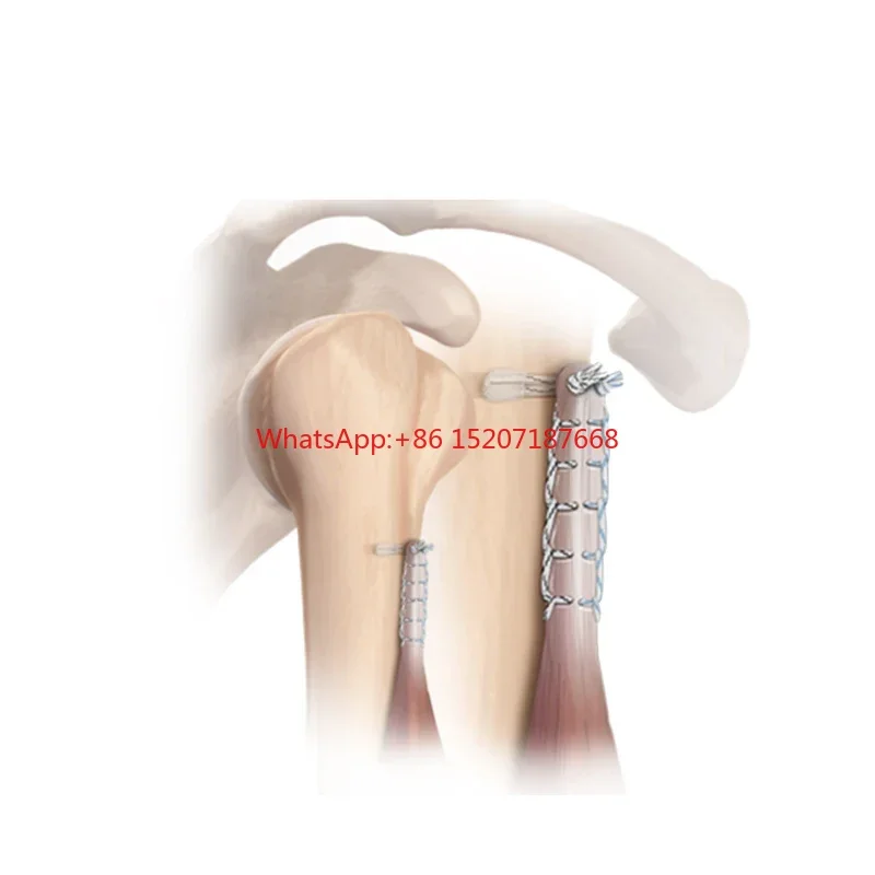 

Non-absorbable Suture Anchor