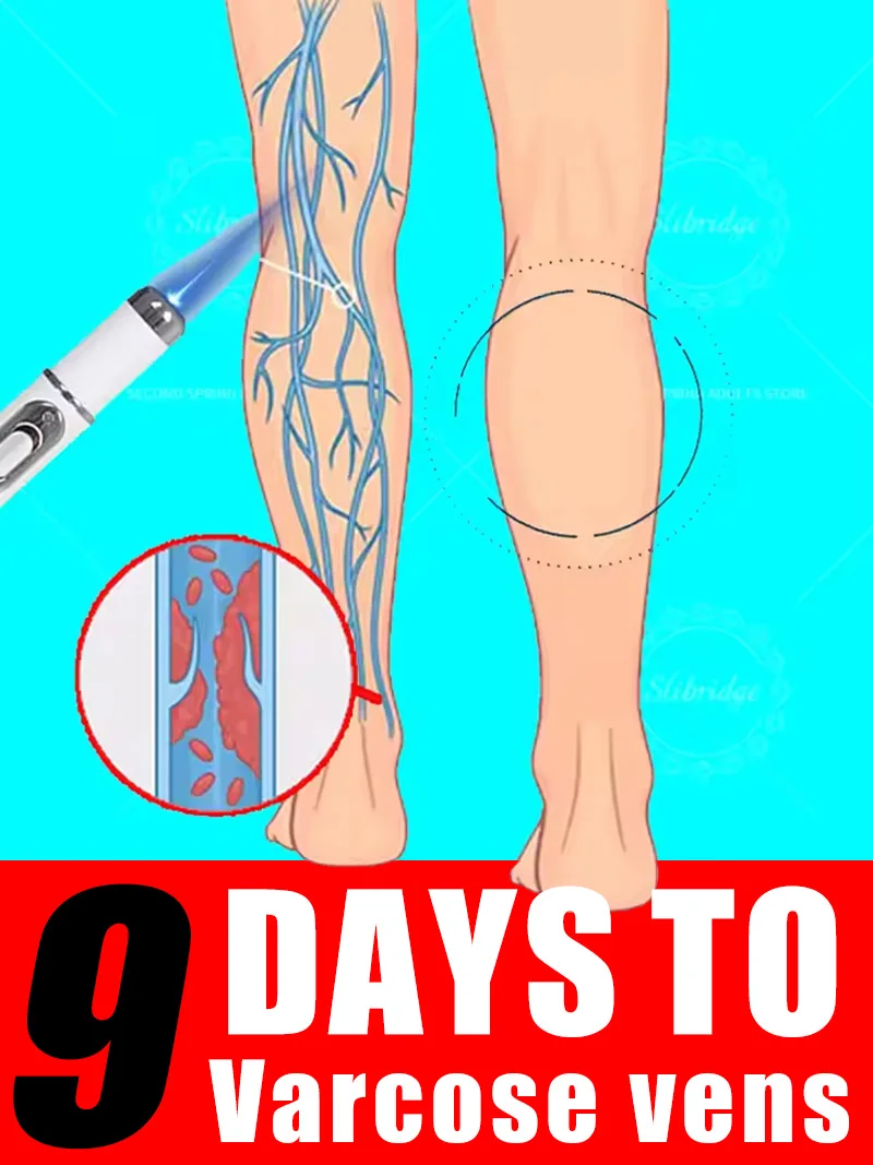 In 7 Days，Generation-2 Laser Says Goodbye To Spider Legs Varicose