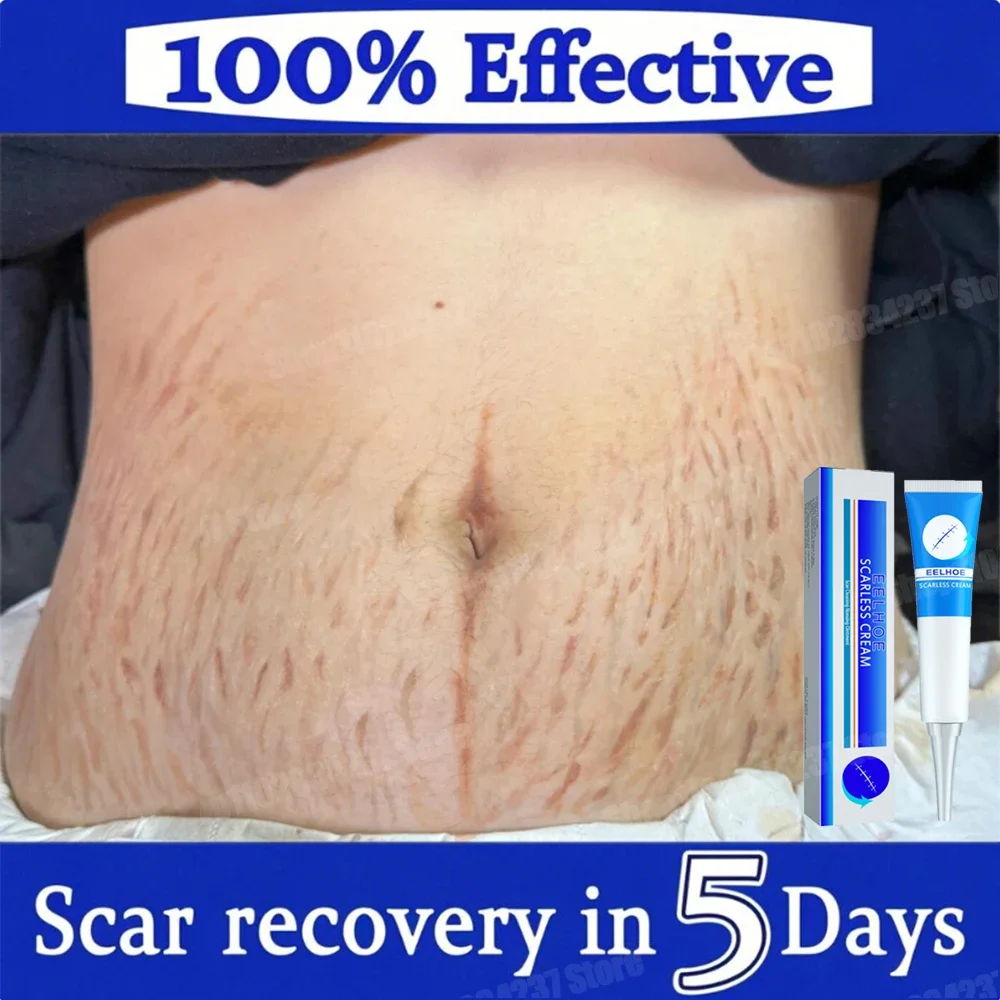 

Postpartum Repair Cream Eliminate Red White Stretch Marks Firming Skin Pregnancy Skin Care