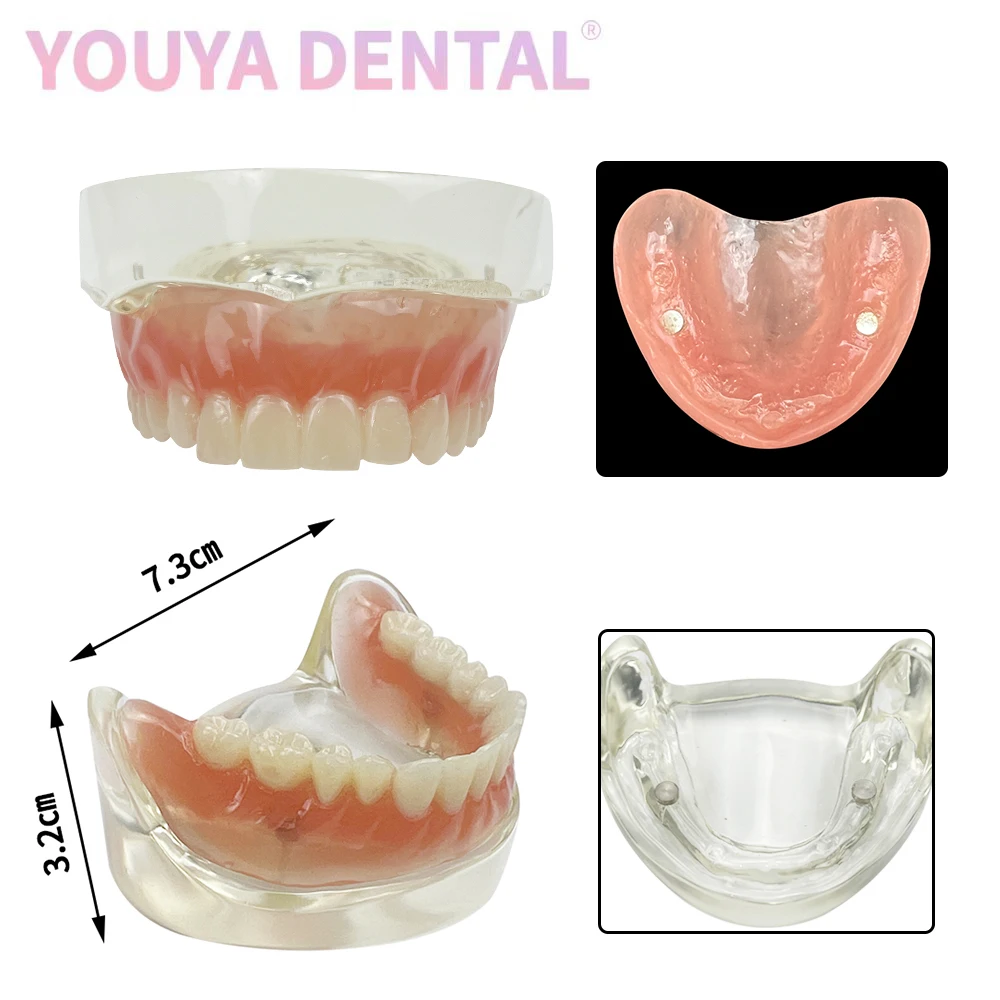 1 Pcs Upper/Lower Jaw Implant Removable Overdenture Tooth Model With 2 Implants Typodont Model Suitable Dentist Teaching Demo