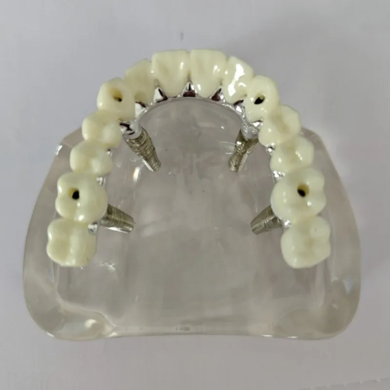 All-on-4 Lab Model | Implant Supported Bridge | Full Arch Teeth Replacement | Adjustable Resin Material